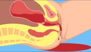 Băng huyết: Nguyên nhân, dấu hiệu và cách xử lý an toàn