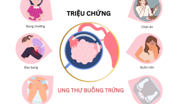 Ung thư buồng trứng: Nguyên nhân, triệu chứng và cách điều trị hiệu quả