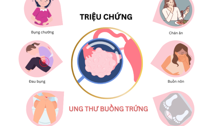 Ung thư buồng trứng: Nguyên nhân, triệu chứng và cách điều trị hiệu quả