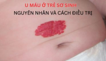 U máu ở trẻ sơ sinh: Nguyên nhân và cách điều trị